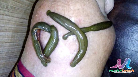 Rational price for First rate leech therapy