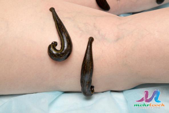 What happens to leeches after leech therapy?