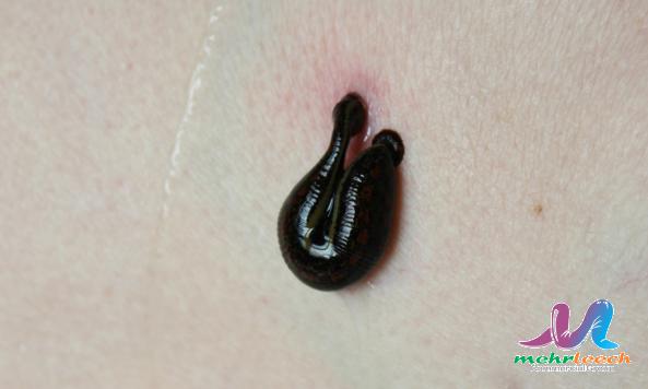 When were leeches first used in medicine?