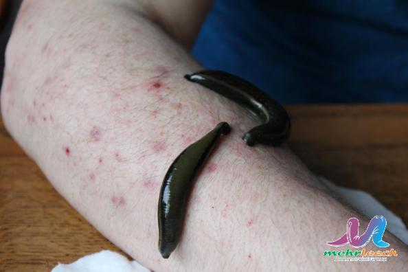 What were leeches used for in victorian times?