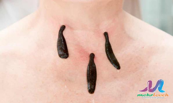 First rate leech therapy cost in 2021