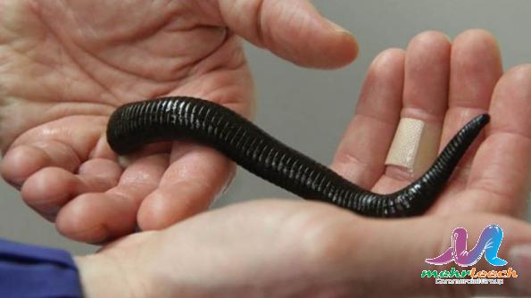 What is leech therapy used for?