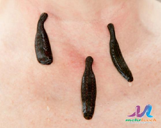 Leech therapy Wholesale Market