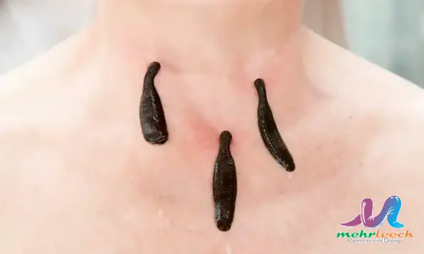 Global demand for leech therapy