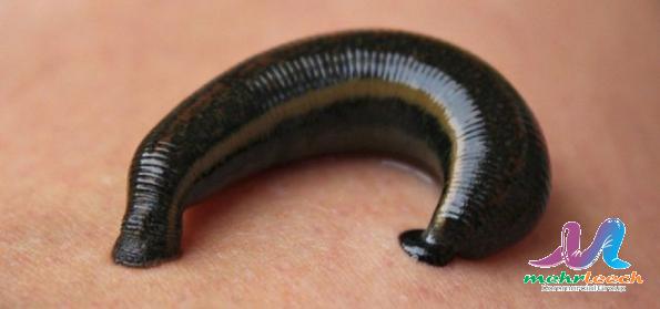 Leech therapy cost in 2021