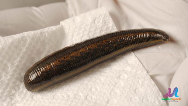 Leech Treatment for Arthritis